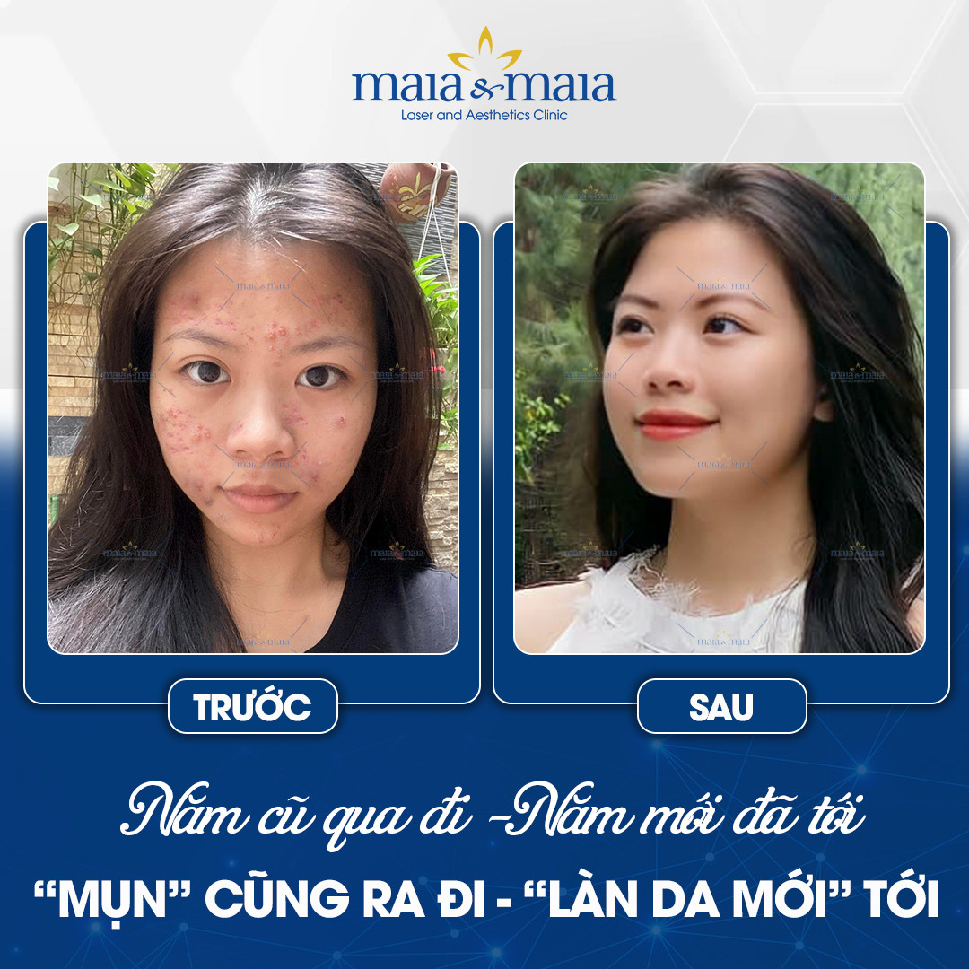 Bài viết quảng cáo trị mụn - Maia&Maia